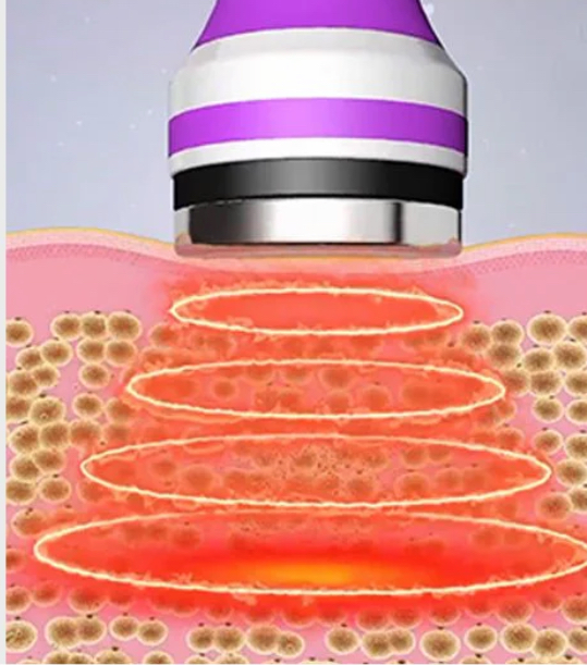 Ultrasonic Cavitation Treatment