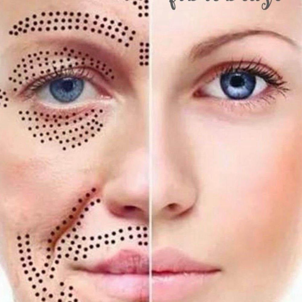 Plasma Fibroblast Face Lift at Glo’s Beauty Creations