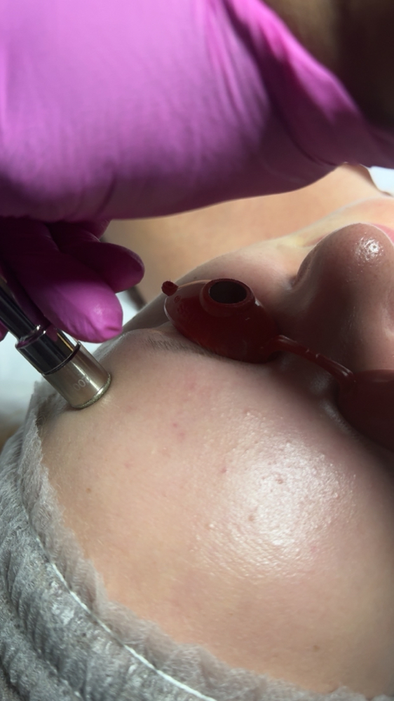 Microdermabrasion Treatment