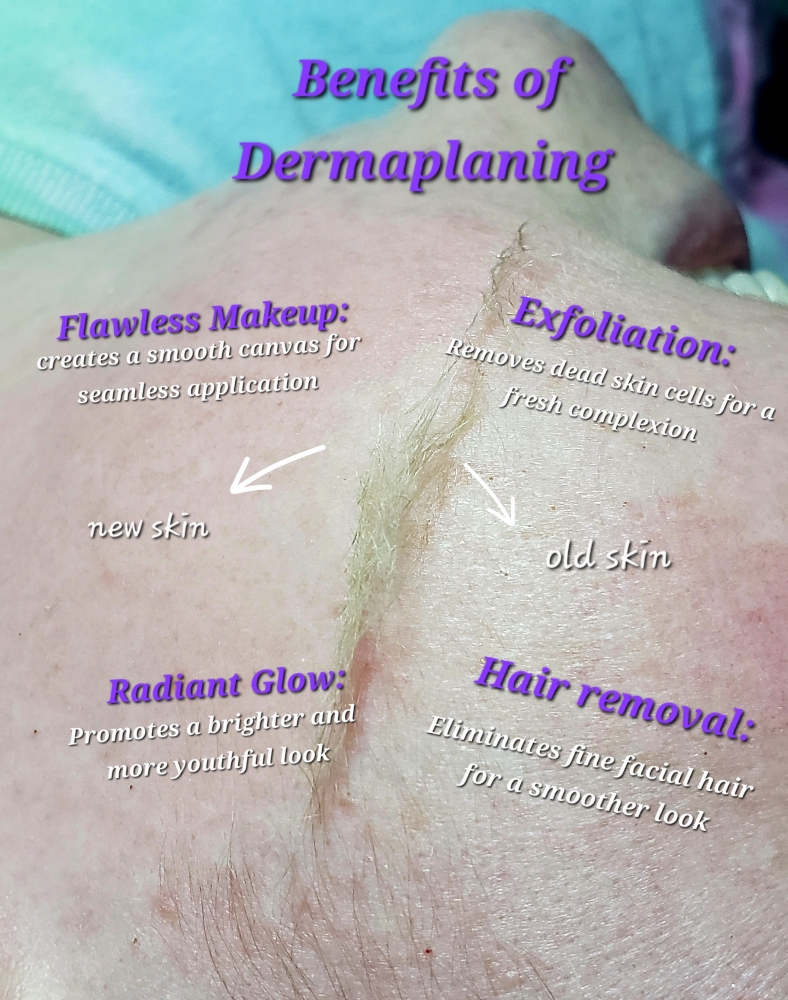 Dermaplaning