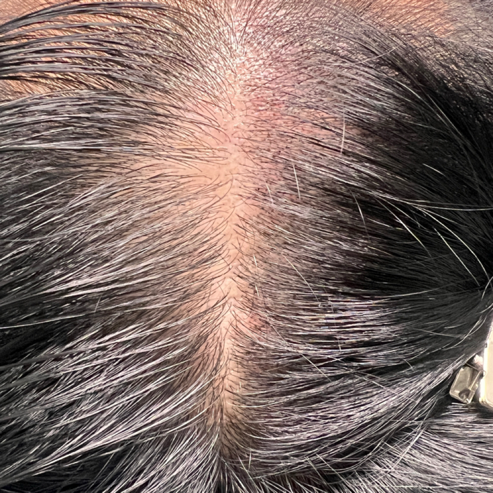 SMP Density Restoration