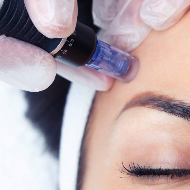 Microneedling & Infusion Therapy