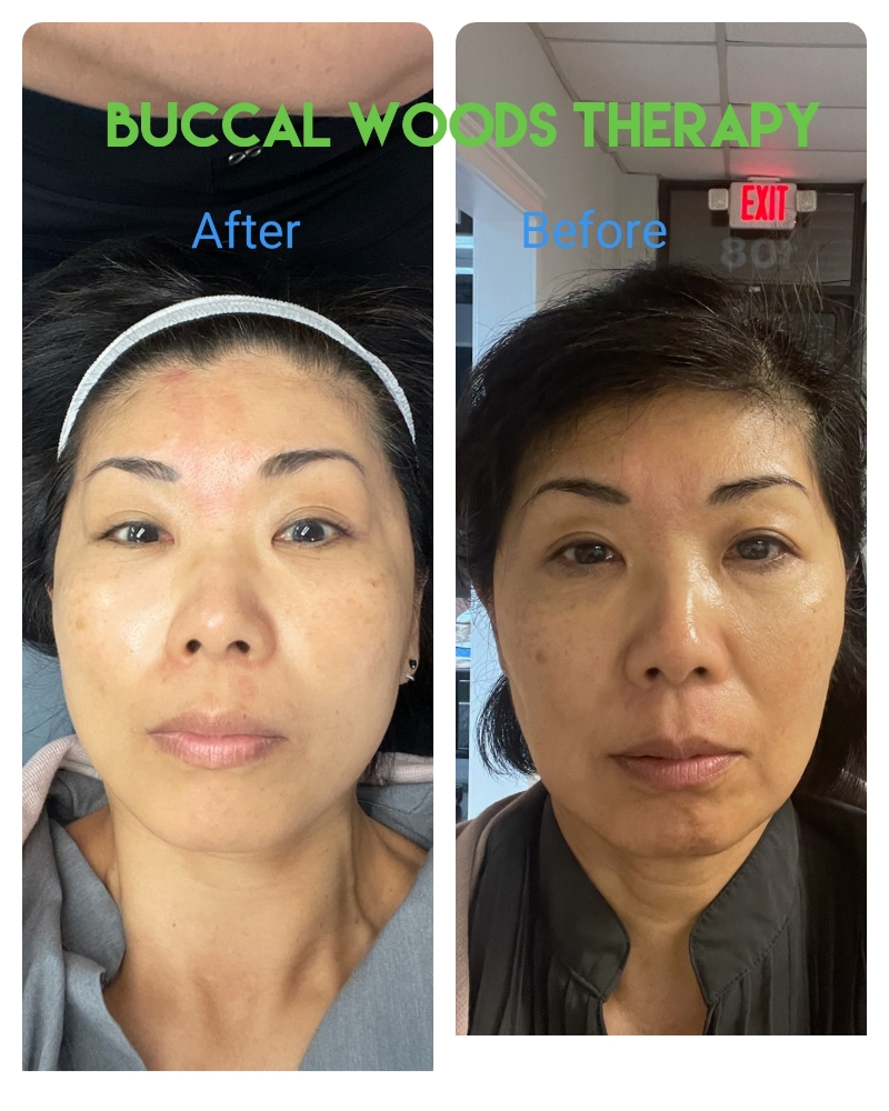 Buccal Woods Facial