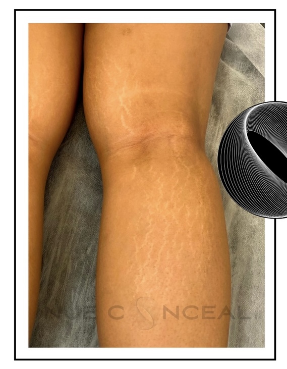 Inkless/Camo StretchM Lower Leg