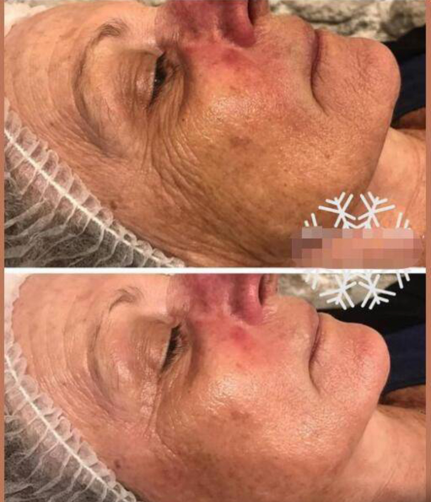 Carbon Laser Fractional CO2 wrinkle