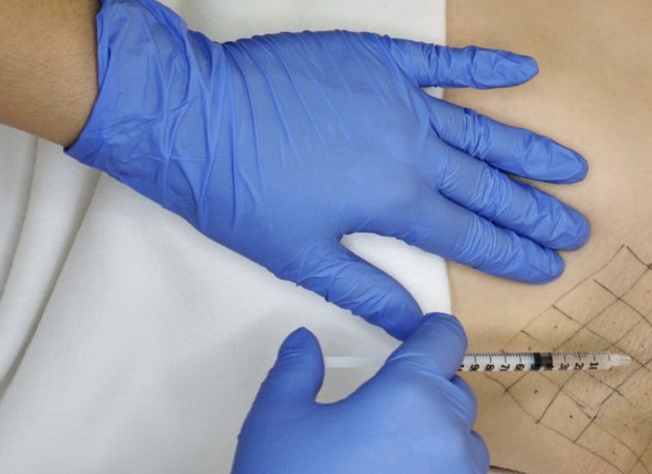 Armpit Tox (Hyperhidrosis)