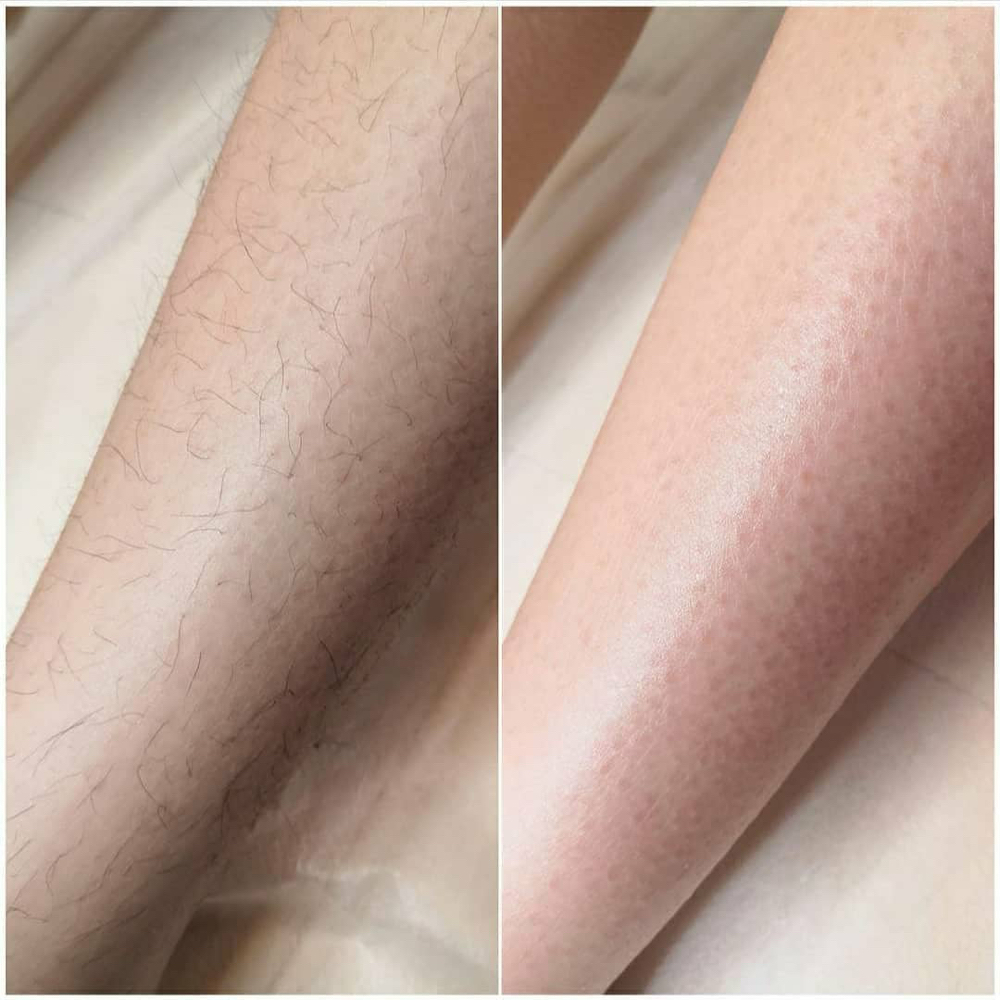 Electrolysis 2 Hours Session