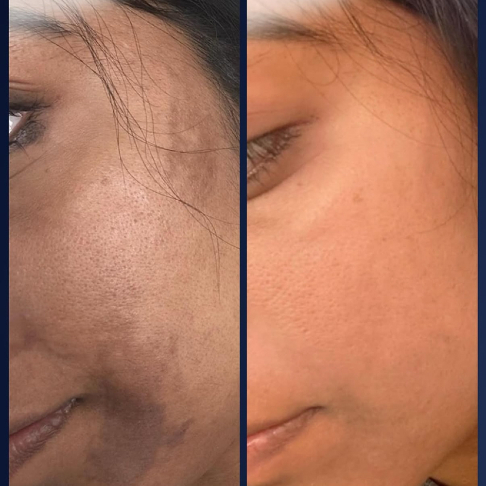 Pigment Correct Peel at Heavenly Esthetics Skincare in Latham, NY