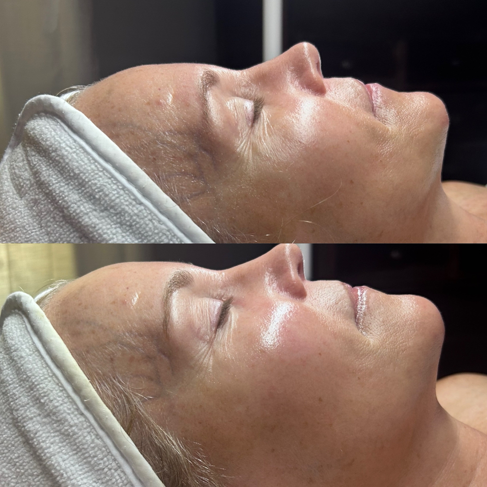 90 Min Beyond Botox Facial