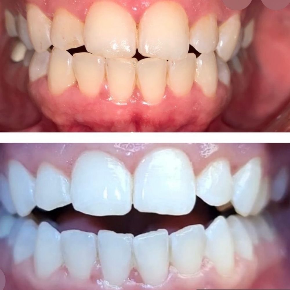 Holistic Teeth Whitening at VitaGrace Aesthetics in Rockwall, TX