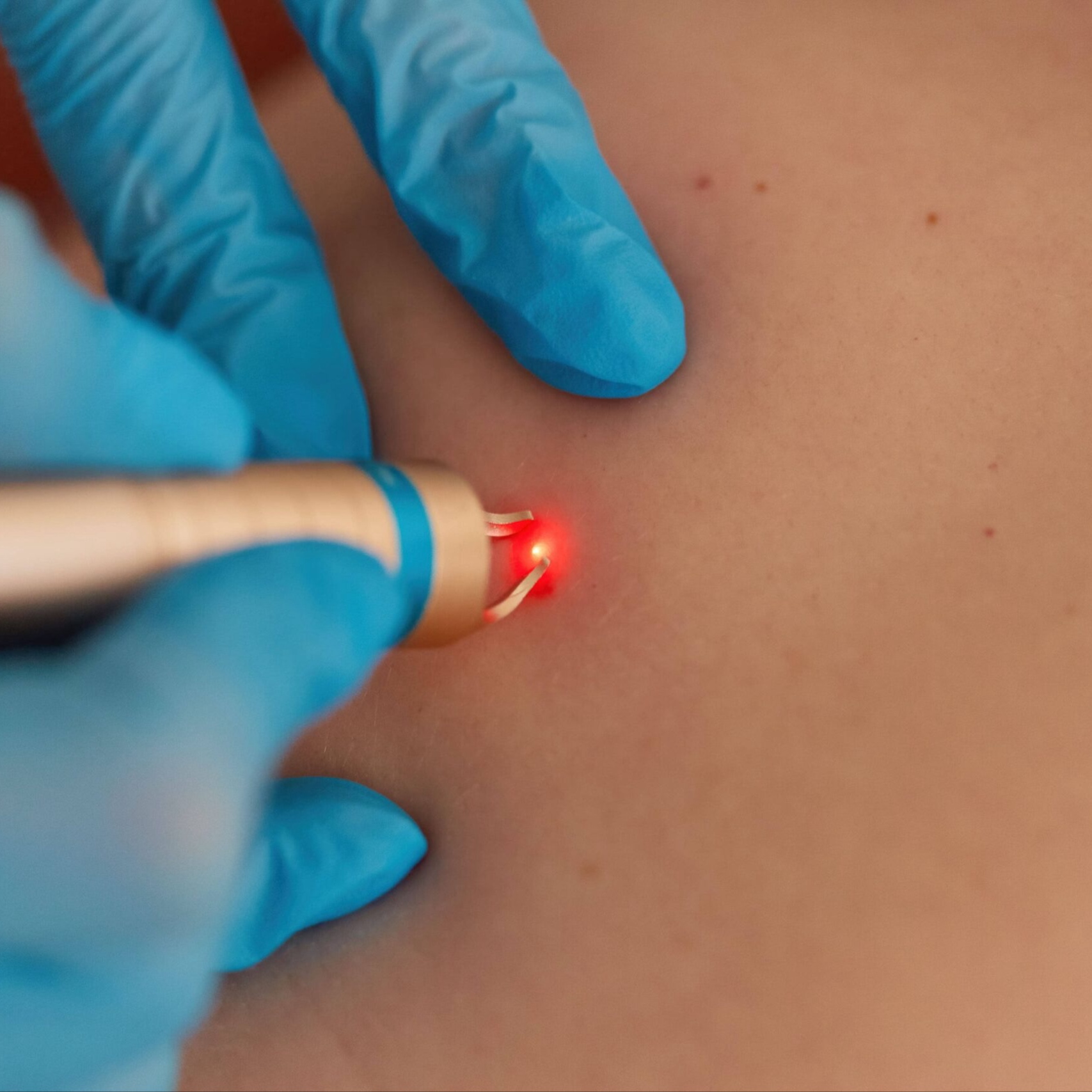 Skin Tag Treatment at Michelle Marie Clinical in Temecula, CA
