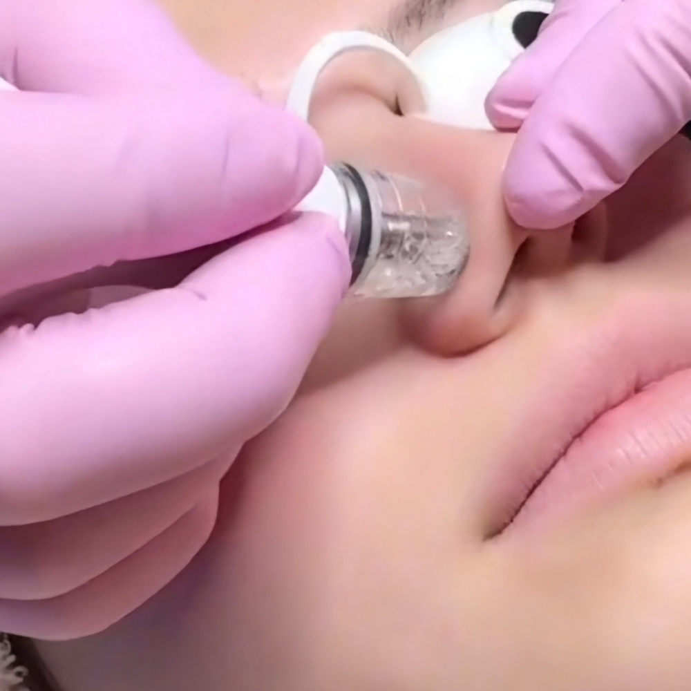 🫧Diamond microdermabrasion 💎 at C|E Esthetics in Moore, OK