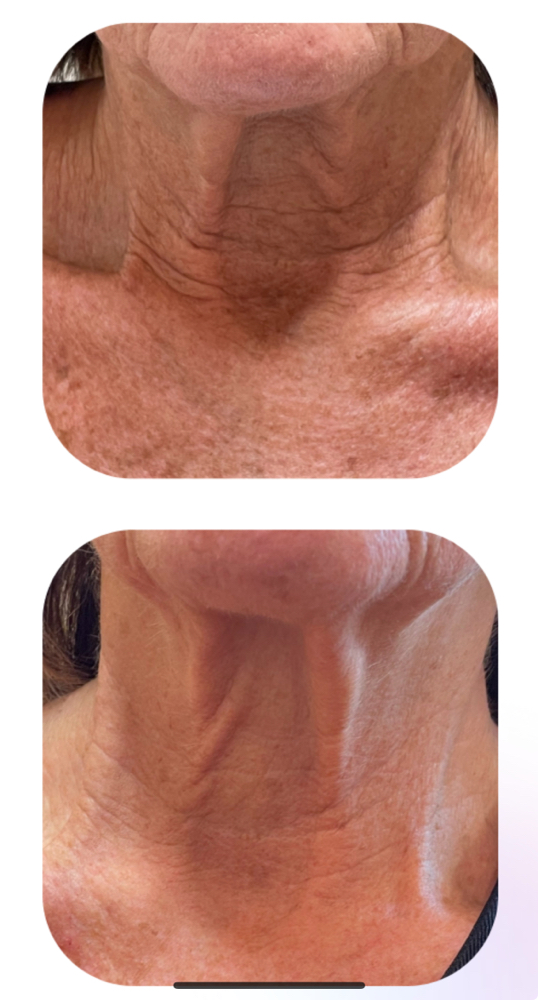 Procell Microchanneling Neck