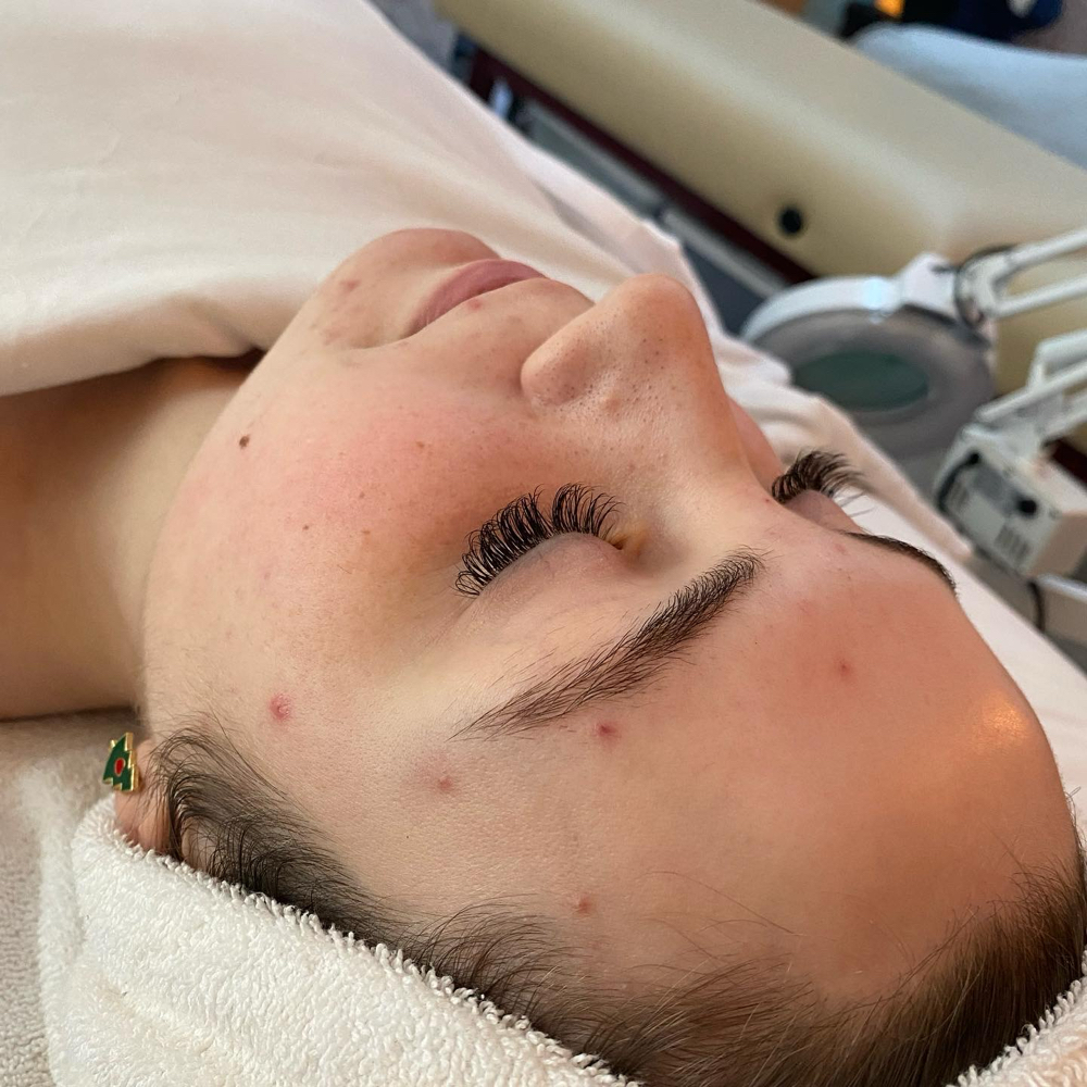 Acne Facial