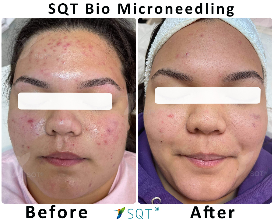 Acne Bio Microneedling Treatment