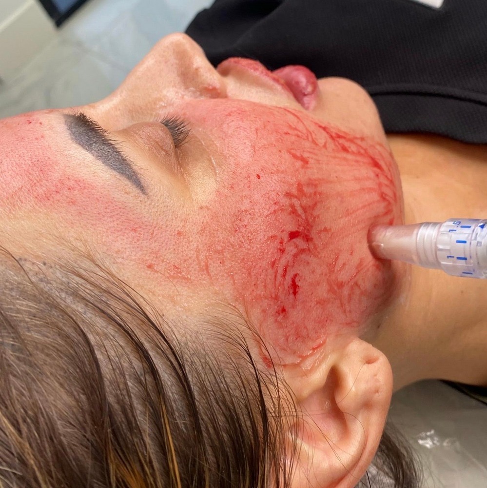 Facial PRP