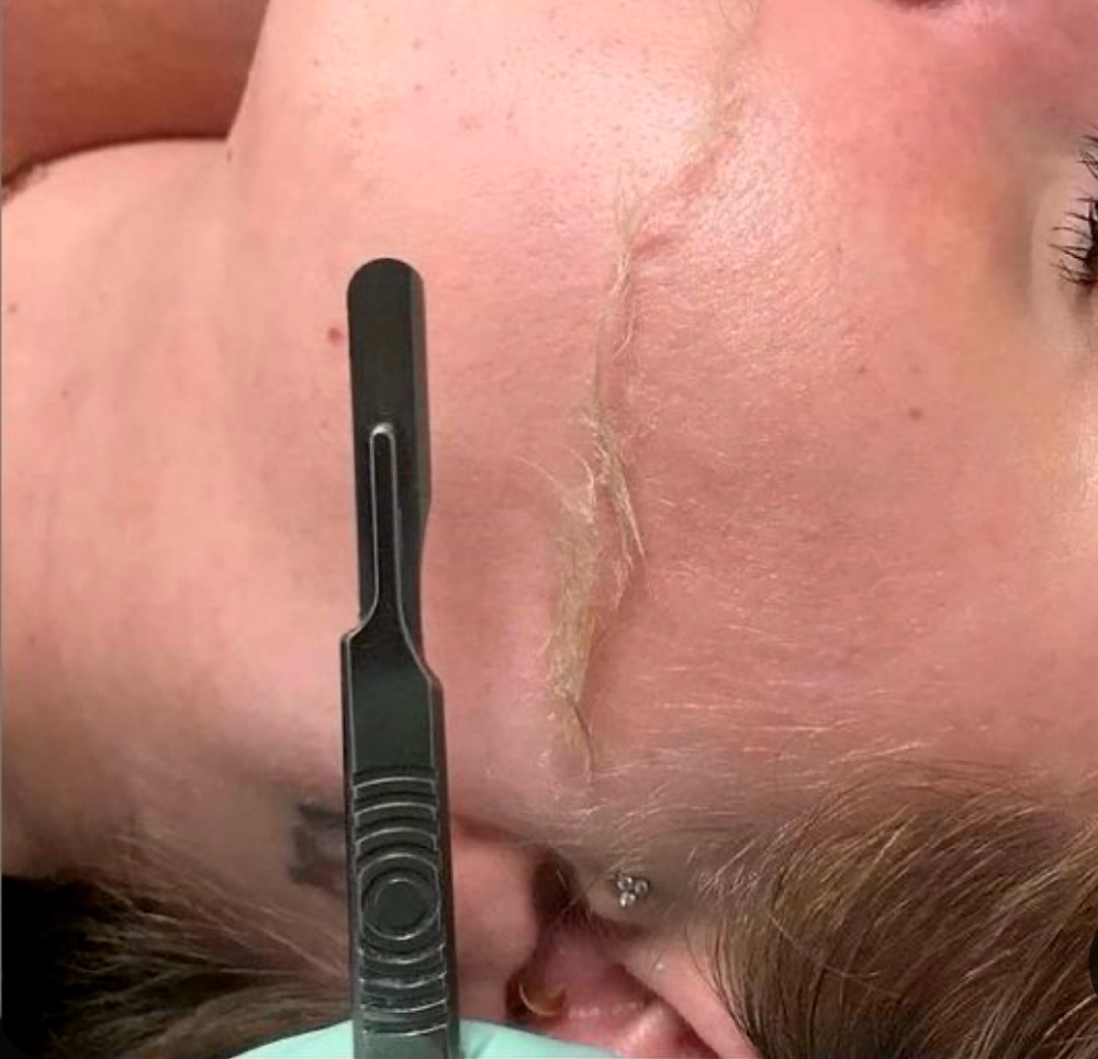 Dermaplane Add-on