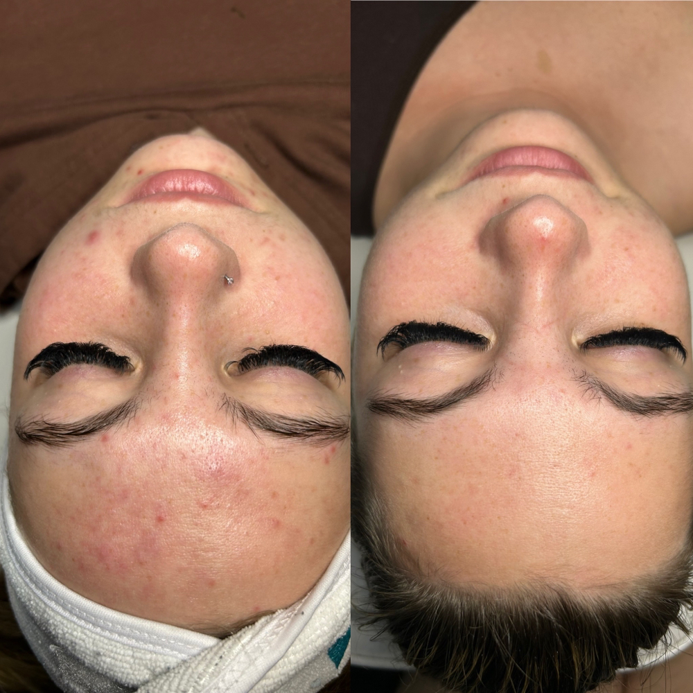 Get Clear Program + Consultation