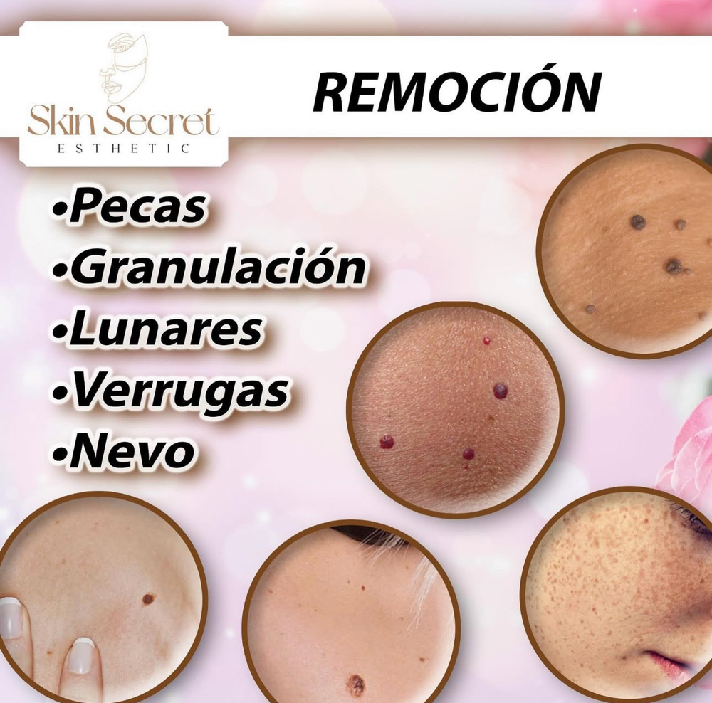 Remocion De verrugas