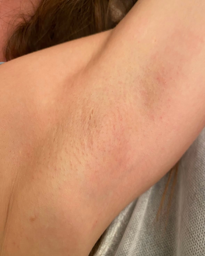 Underarms