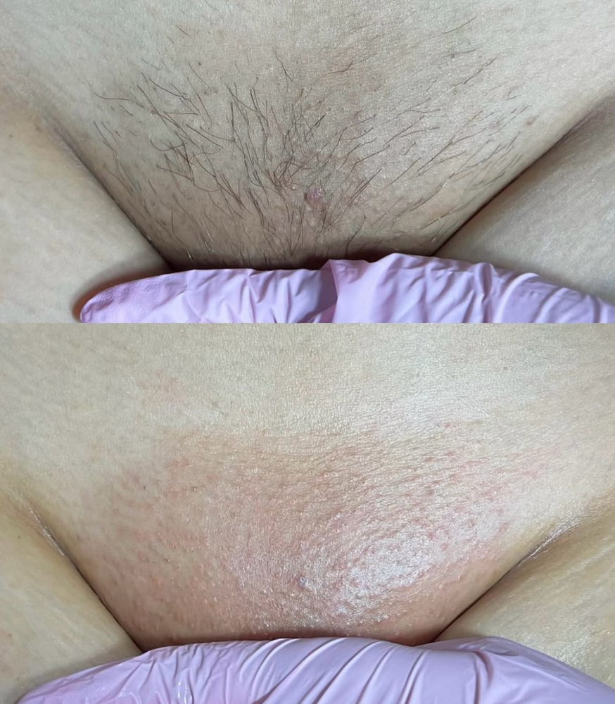 Brazillian Wax