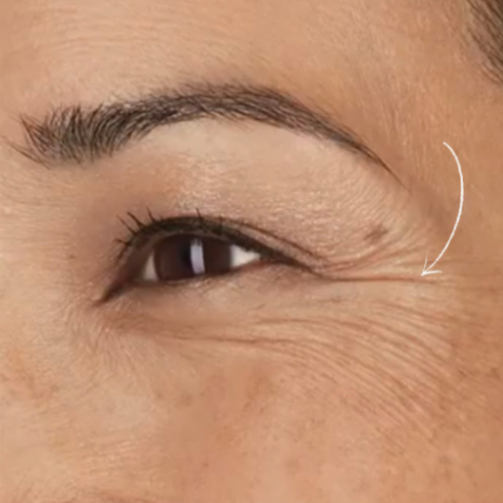 Crows Feet Botox at Glow Studio in San Antonio, TX