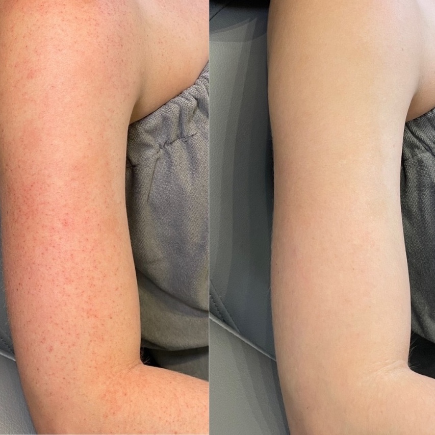 BBL Full Arms at The Skin Concierge in Northbrook, IL