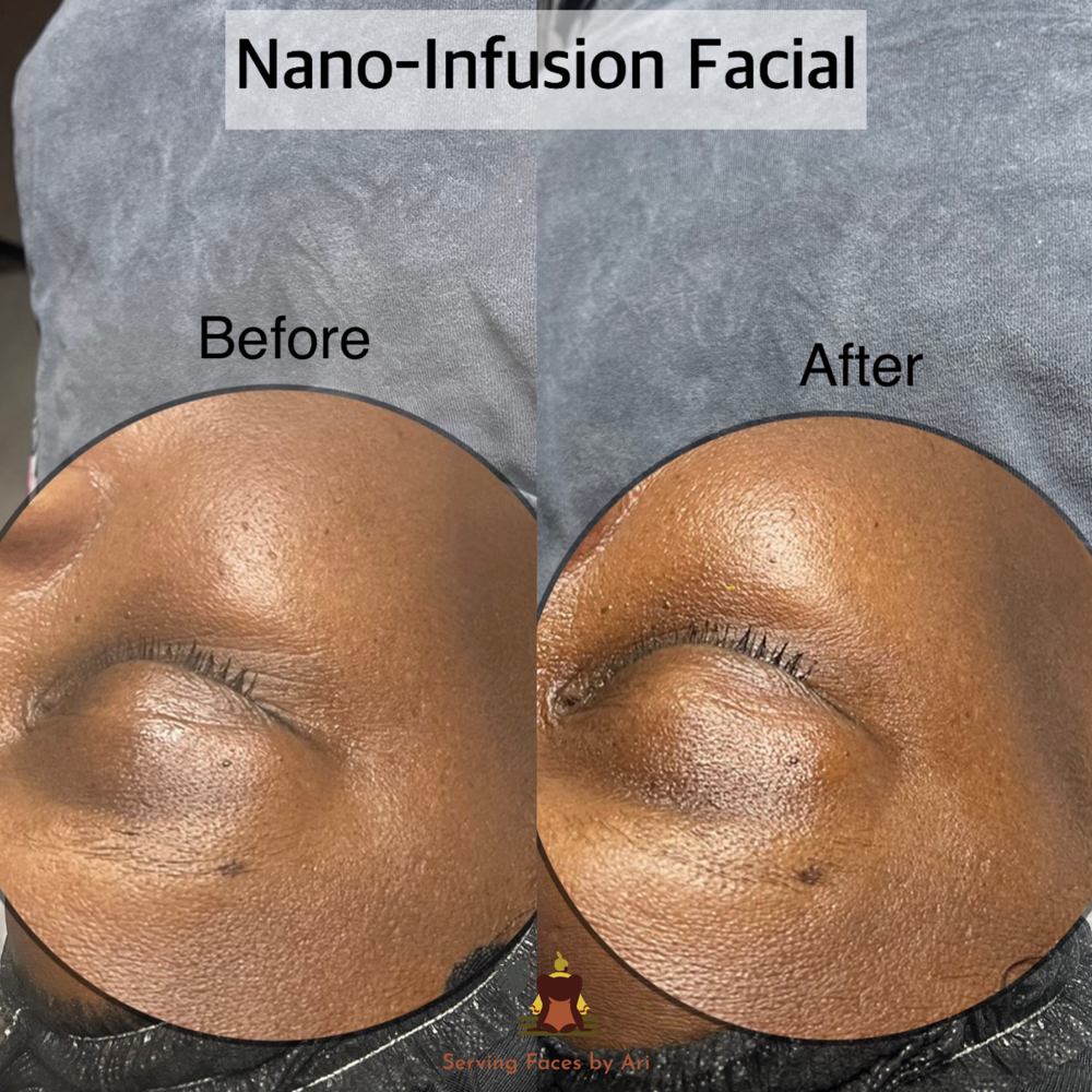 Nano-Infusion Facial