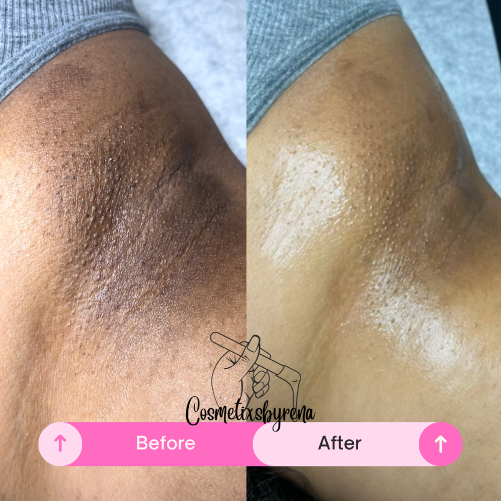 Underarm Skin Lightening
