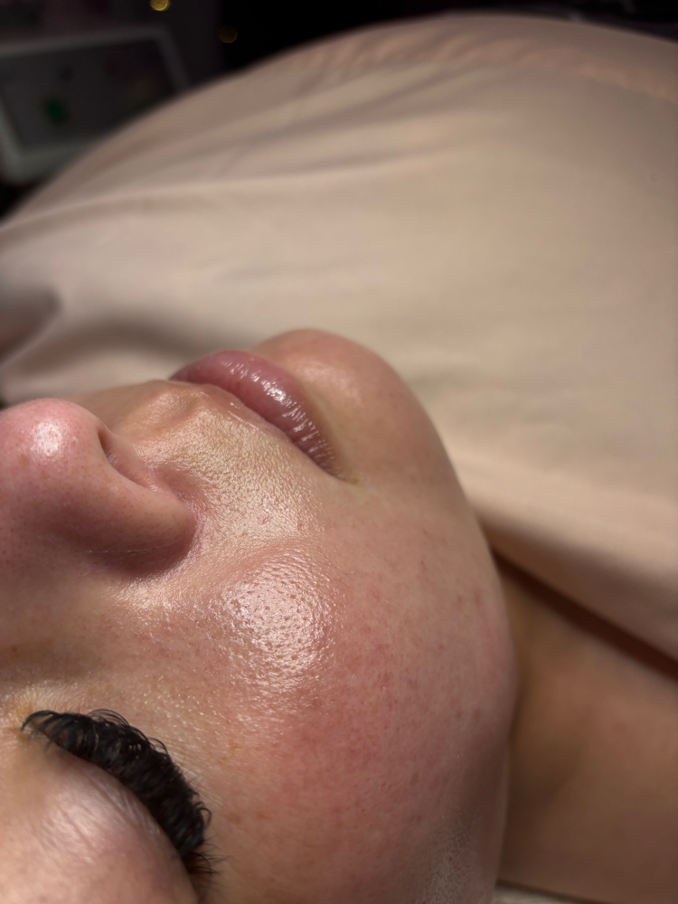 Dermaplane Facial
