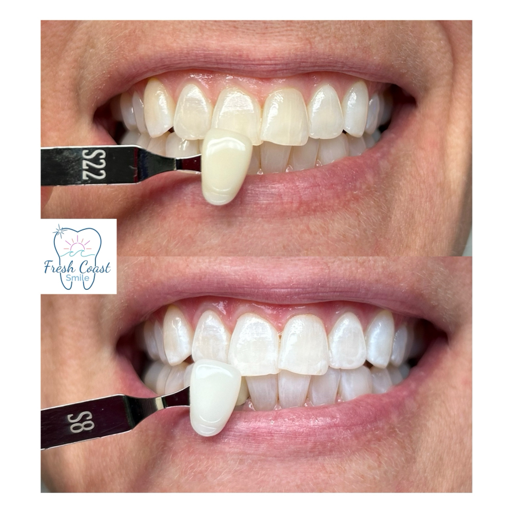 Spring Promo πΈβοΈ 60 Min. Whitening at Fresh Coast Smile in Marquette, MI