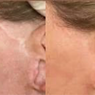 Scar Camouflaged at MFMicroblading in Randolph, MA