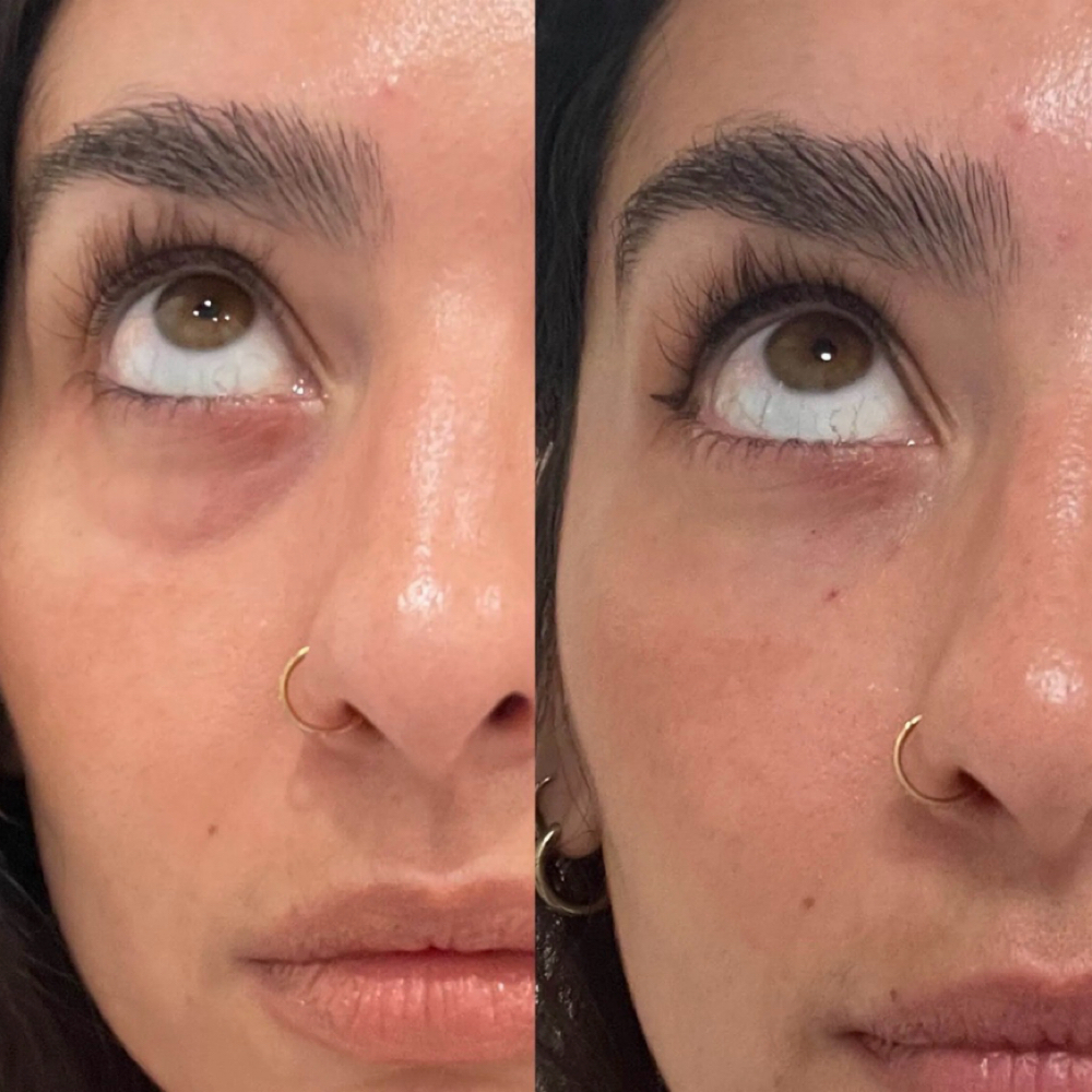 PRP Undereye Rejuvenation at Vain Beauty Aesthetics in De Queen, AR