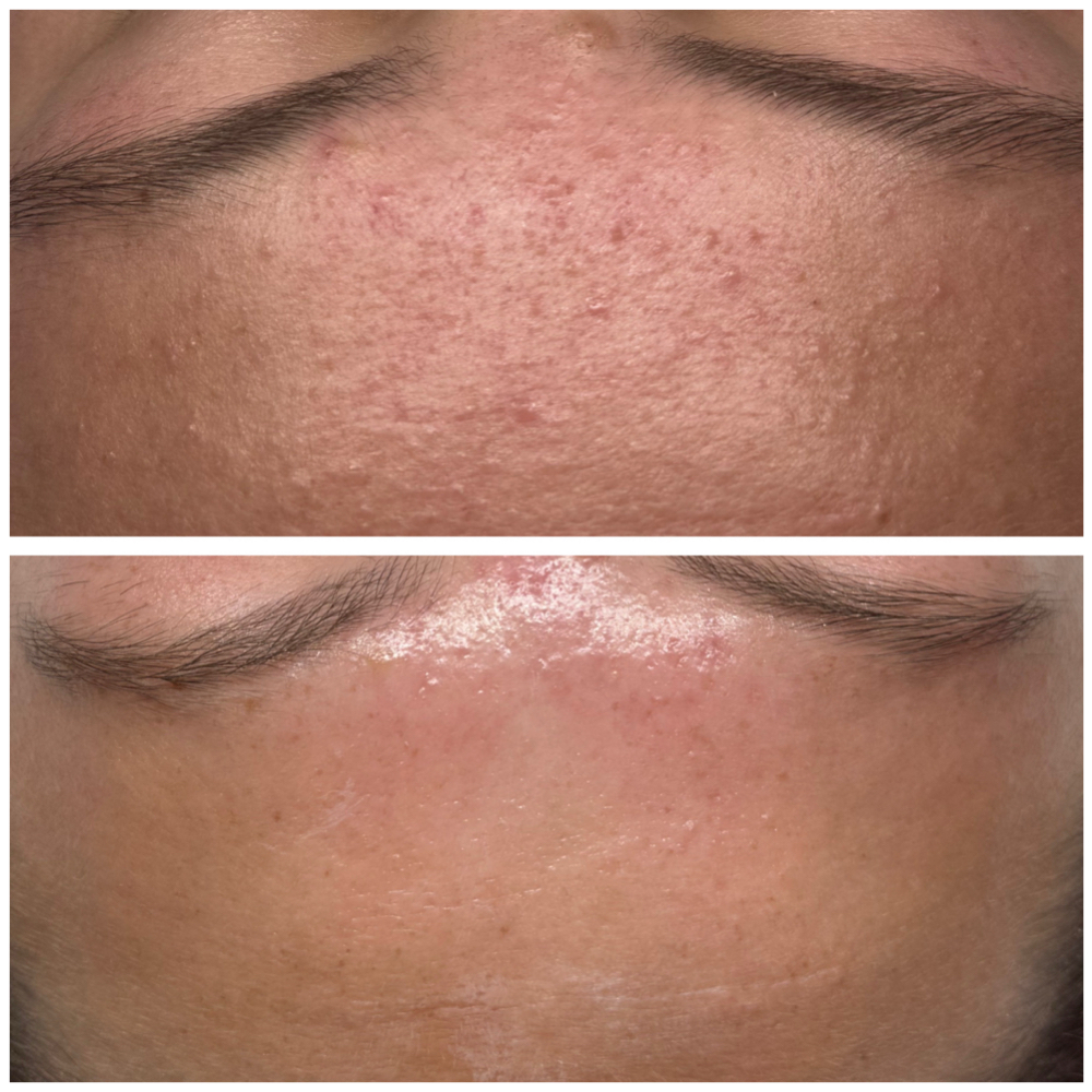 Phecial™ Corrective Peel at Phe Michelle Beauty in Texarkana, TX