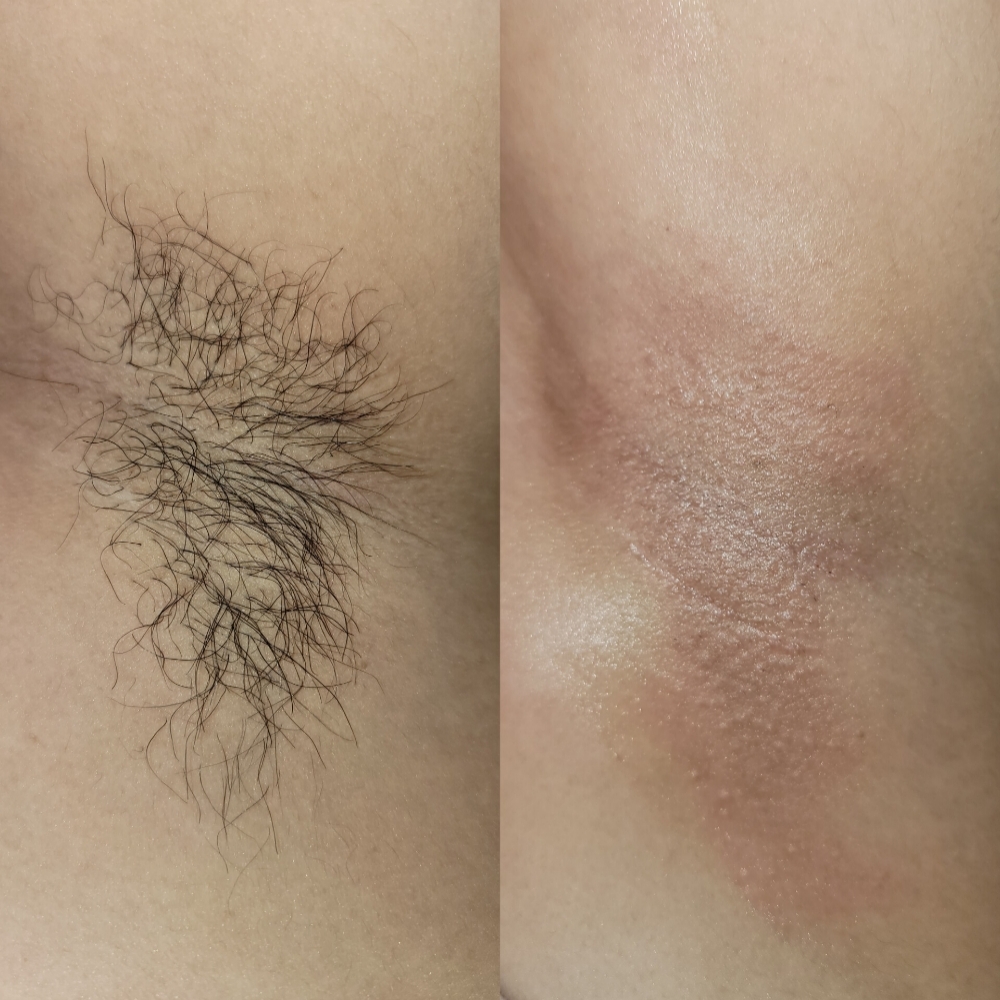 Under Arm Wax at Bubalu Skin in Elgin, IL