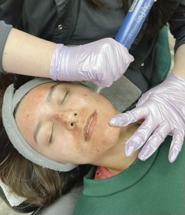 SkinPen Microneedling