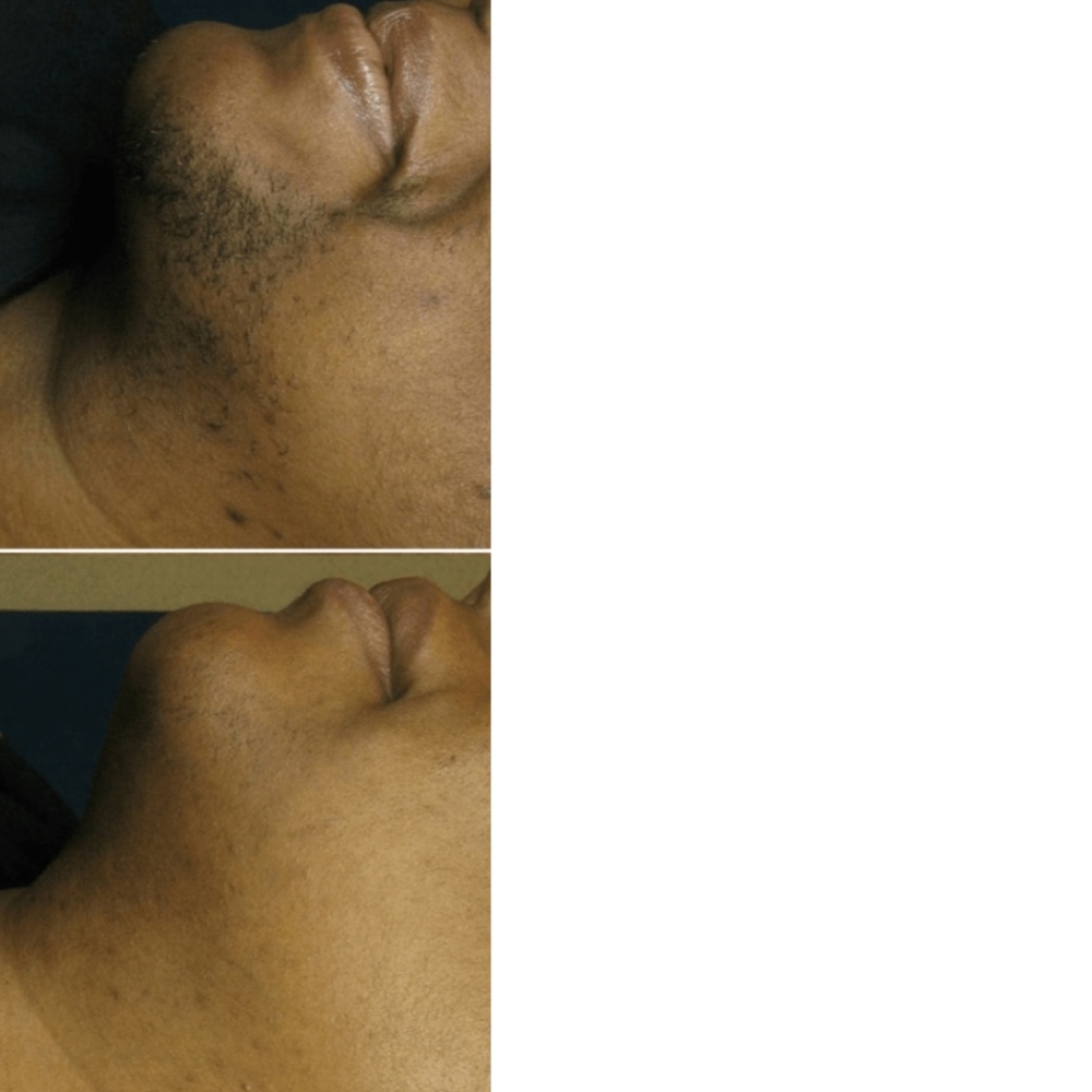 Full Chin Wax