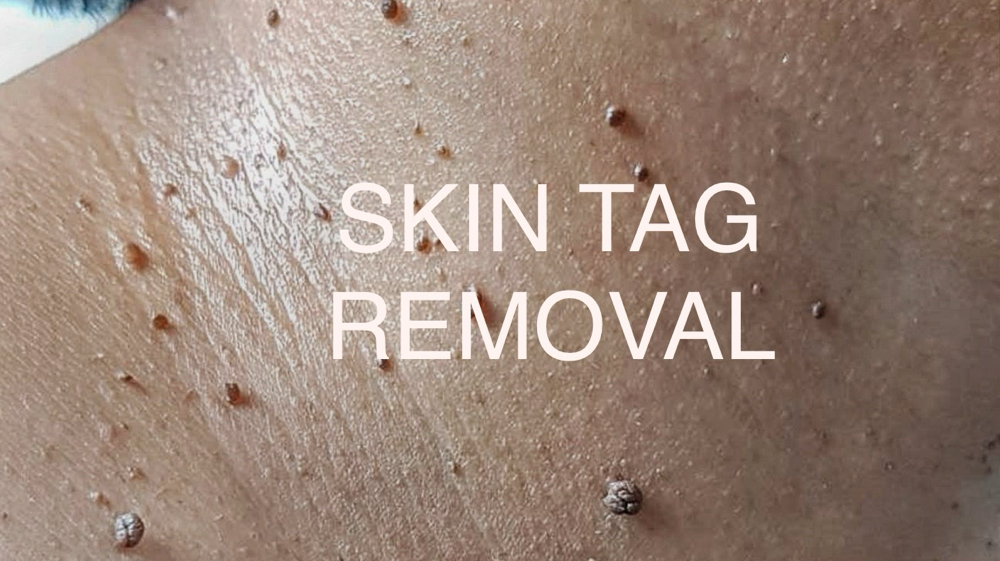 SKIN TAG REMOVAL