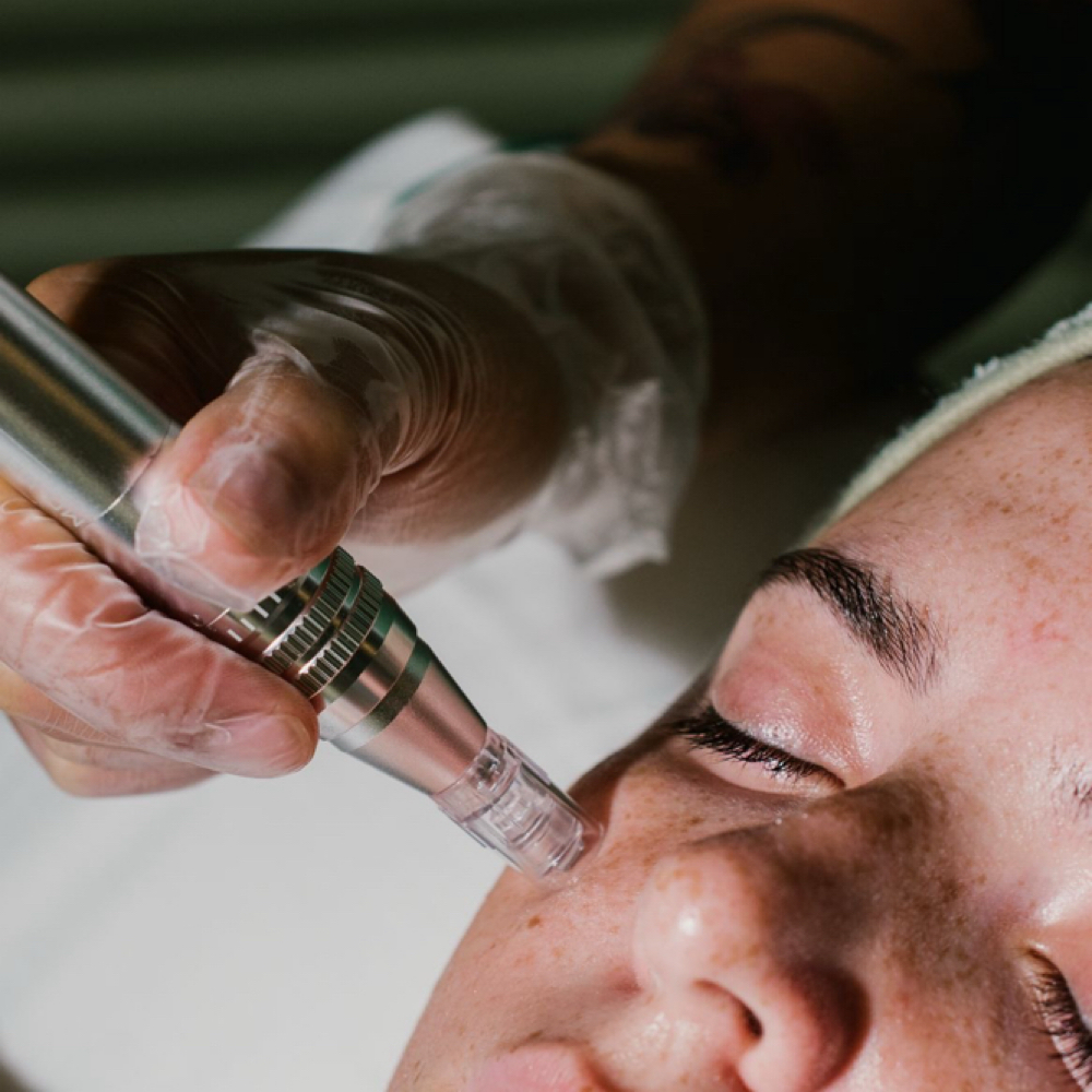 Collagen Induction Facial at SalasBeautyCo. in Gilbert, AZ