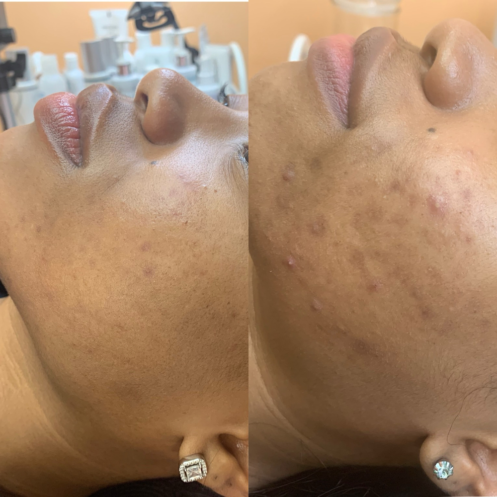 Acne Clear Facial