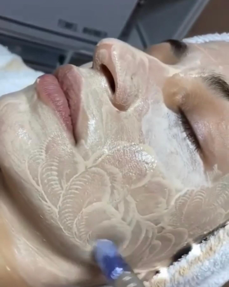 Microneedling