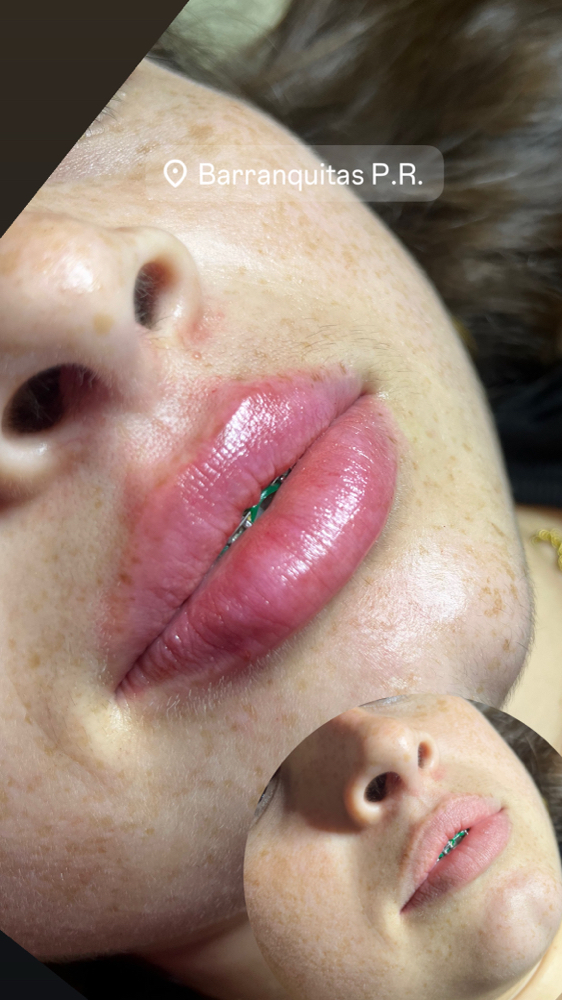 Hidratacion De Labios at Dream Body Esthetic in Orlando, FL