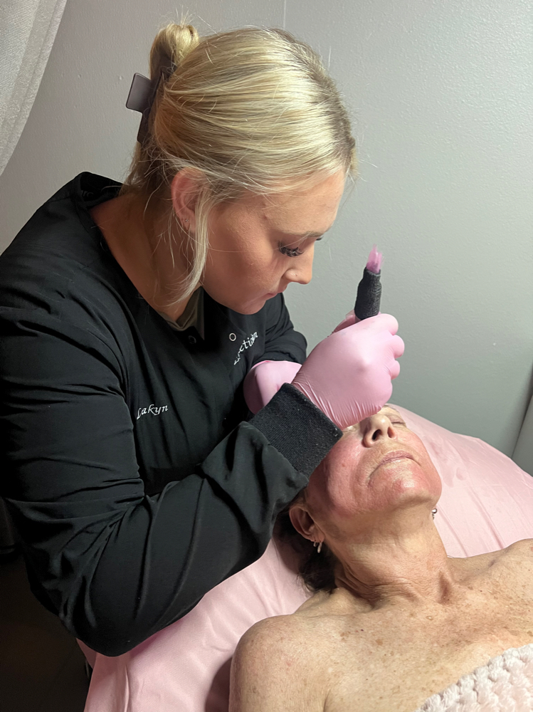 Microneedling- 1 Session