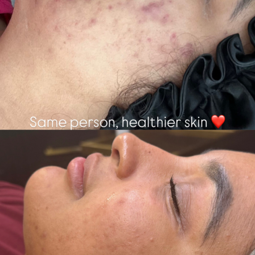 Acne clinic Sponsorship at BadBeeLashes in Temecula, CA