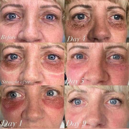 Upper Eyelid & Lower Eyelids