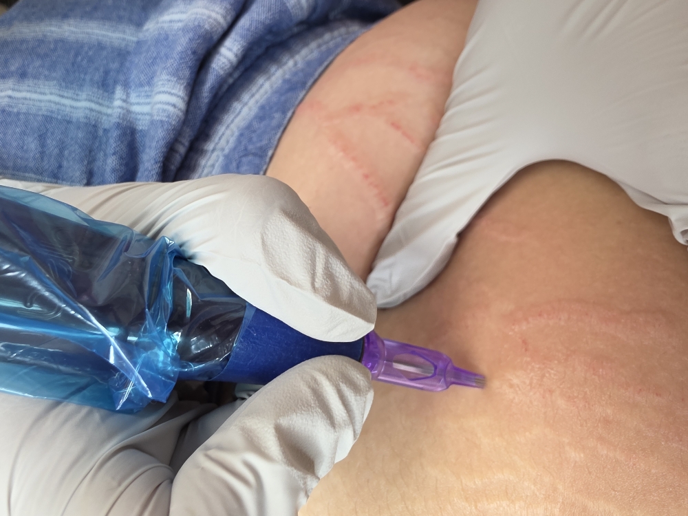 Microneedling