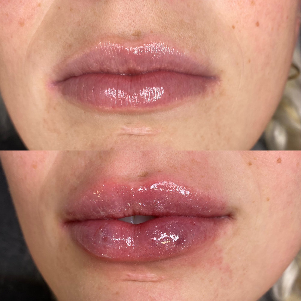 2ML HA Lip Filler