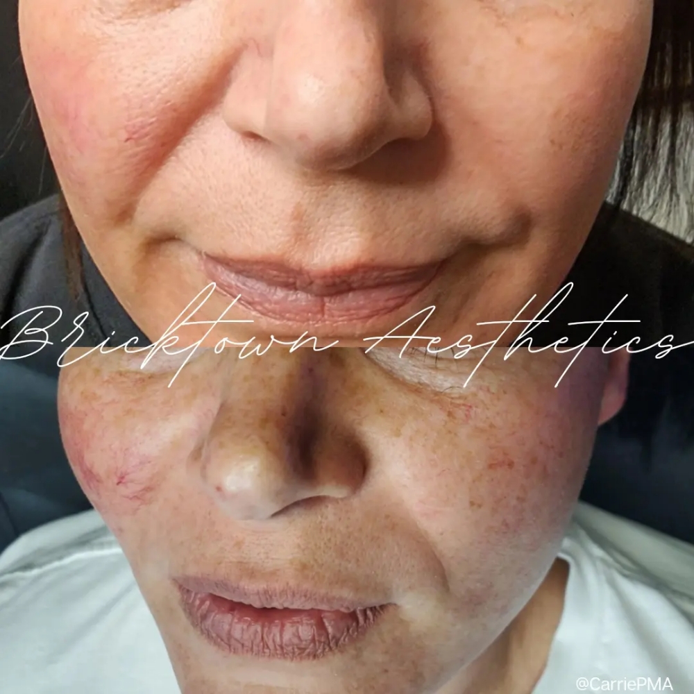 Advanced Rejuvenation Peel