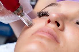 Microneedling Face Treatment