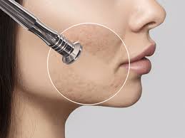 Diamond Microdermabrasion